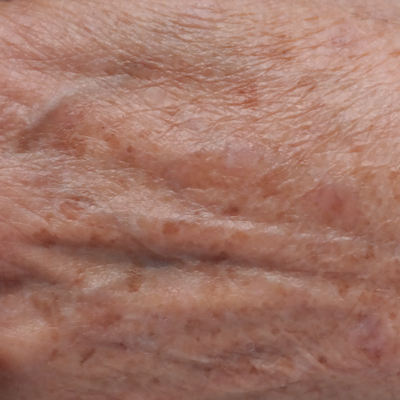 pigmentové skvnry na pleti