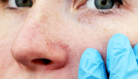 Kozmetička radí ako na červené žilky a citlivú pleť