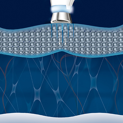 sekvenční ultrazvuk - napuštění aktivními látkami